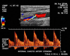 Carotid Artery Disease – Northern Sydney Vascular